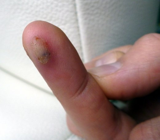 Injured right ring finger